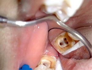 лечение зубных каналов